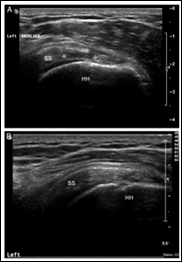 Arthroscopic Rotator Cuff Repair | Tendon Integrity